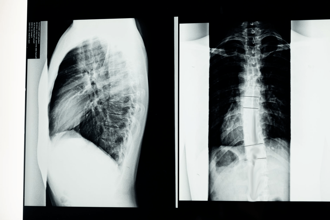 osteochondrosis an spine ceirbheacsach sa phictiúr