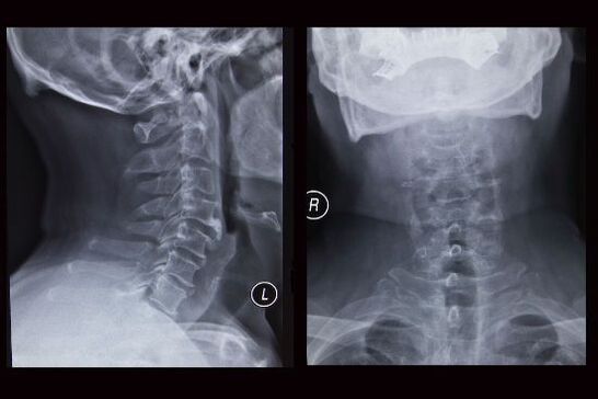 Íomhá X-gha den spine ceirbheacsach (tá osteochondrosis ag an othar)