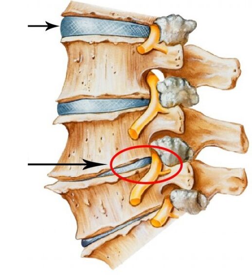osteochondrosis cheirbheacsach