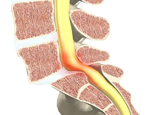 Deighleog Motor Fola le haghaidh osteochondrosis