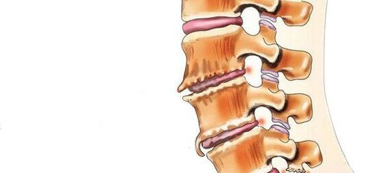 Spondylosis - Scriosadh na n -alt interveirteabrach