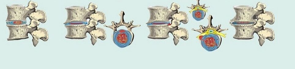 céimeanna éagsúla de osteochondrosis chliabhraigh