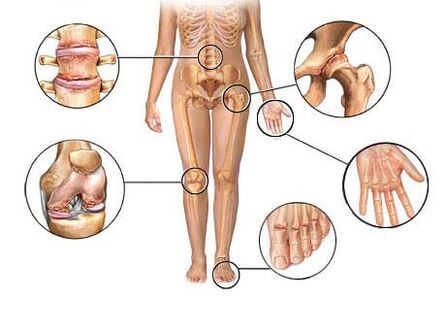 arthrosis tionchar joints éagsúla