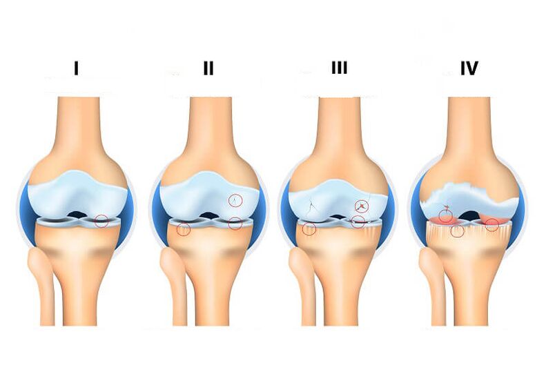 céimeanna arthrosis comhpháirteacha a dhéanamh