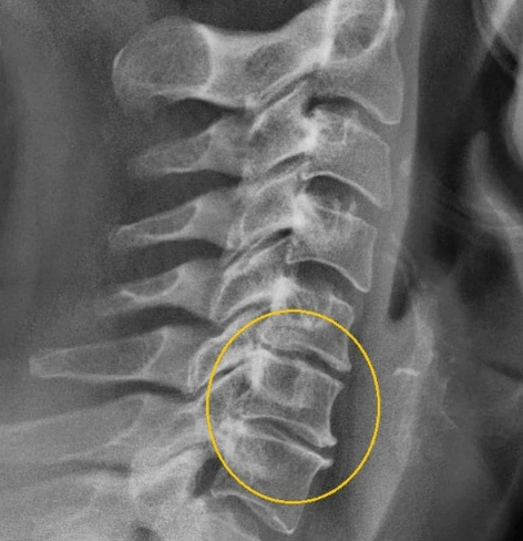 osteochondrosis ceirbheacsach