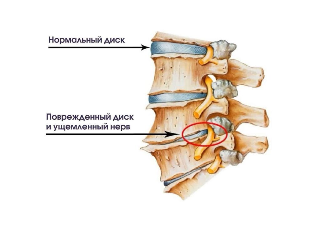 Comharthaí osteochondrosis ceirbheacsach