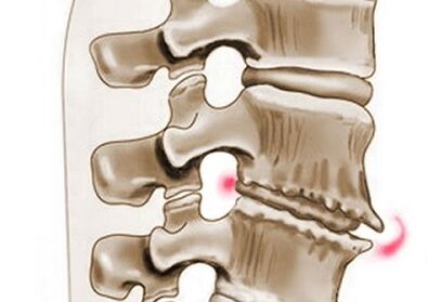 damáiste do na veirteabraí in osteochondrosis thoracach