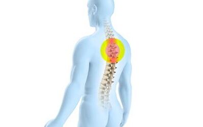 osteochondrosis an spine chliabhraigh